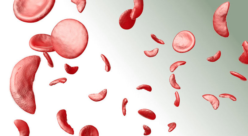 Know about sickle cell anaemia, which got special mention in Union Budget